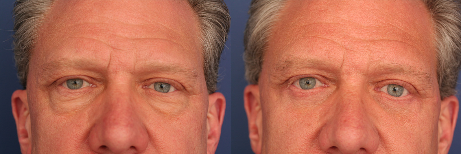 lower eyelid,singleeyelid eyelid surgery