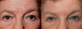 Botox before after