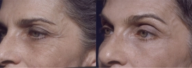 Botox browlift