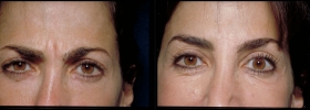 Botox Forehead injections