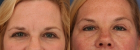 Dysport before after