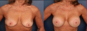 Breast augmentation and lift