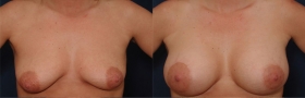 Saline implants & peri-areolar breast lift