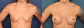 Breast Augmentation