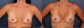 Breast Agugmentation - Saline Implants
