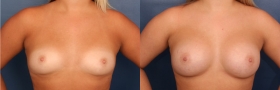 Before & After Breast Augmentation