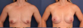 Breast Augmentation with Left Superior Crescent Lift