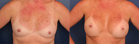 Before & After Breast Augmentation