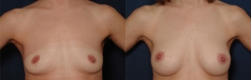 Before & After Breast Augmentation