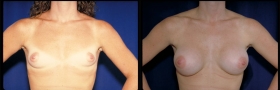 Before & After Breast Augmentation