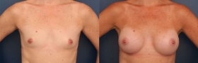 Before & After Breast Augmentation