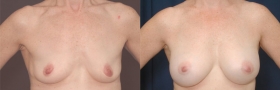 Before & After Breast Augmentation