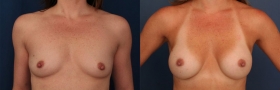 Before & After Breast Augmentation