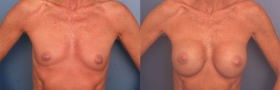 Before & After Breast Augmentation