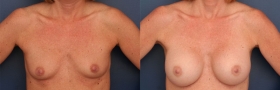 Before & After Breast Augmentation