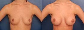 Before & After Breast Augmentation