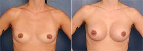 Before & After Breast Augmentation