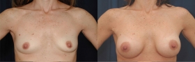 Before & After Breast Augmentation