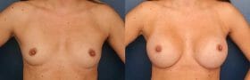Before & After Breast Augmentation