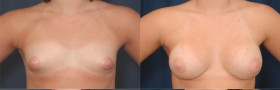 Before & After Breast Augmentation