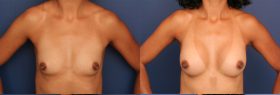 Breast Augmentation with Shaped Implants