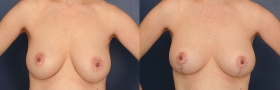 Breast Lift