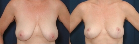 Modified Wise Mastopexy.
