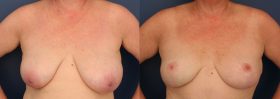 Modified Wise Pattern Breast lift
