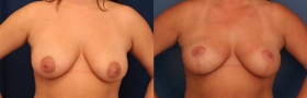 Mastopexy