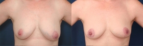 Periareolar Mastopexy breast lift