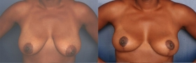 Breast lift