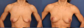 Breast lift and nipple reduction