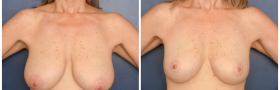 Mastopexy