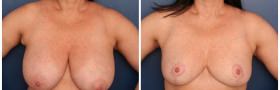 Breast Reduction