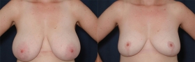 Breast reduction Baltimore