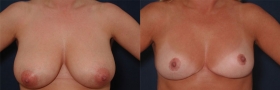 Before after breast reduction