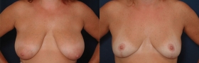 Breast reduction pictures
