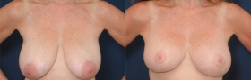 Best breast reduction
