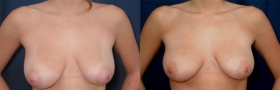 Breast Reduction with Liposuction