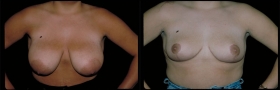 Breast reduction photos