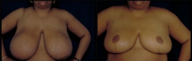 Nipple Graft Breast Reduction