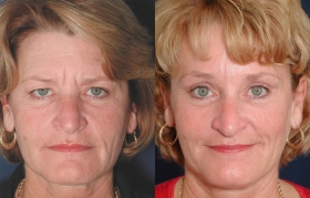 Before after brow lift Baltimore