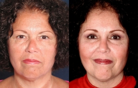 Before after brow lift photos