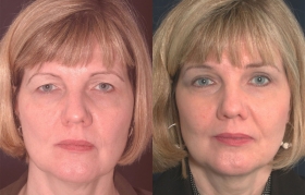 Before after forehead lift photos