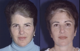 Before after forehead lift pictures