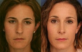 Brow lift surgery results