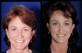 Brow lift surgery results