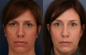 Best brow lift