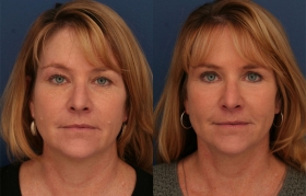 Forehead lift surgery results
