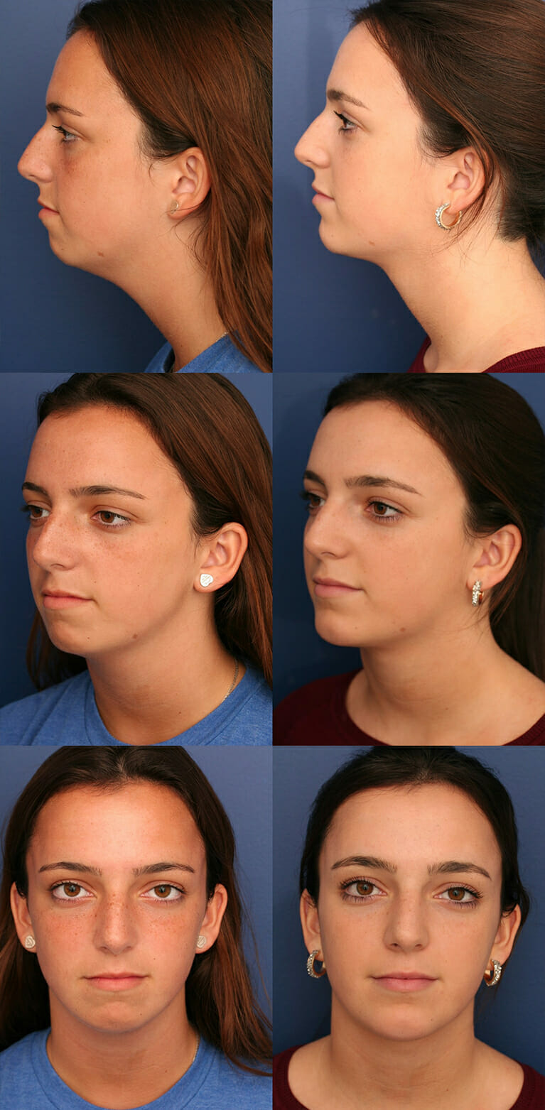 chin lift neck surgery results before implant augmentation vary individual dr